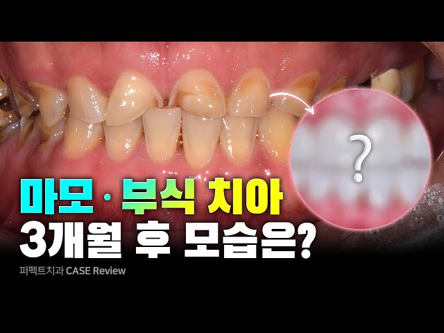 마모, 부식으로 닳아진 치아... 전악보철🦷 [올세라믹, 지르코니아, 라미네이트, 임플란트]