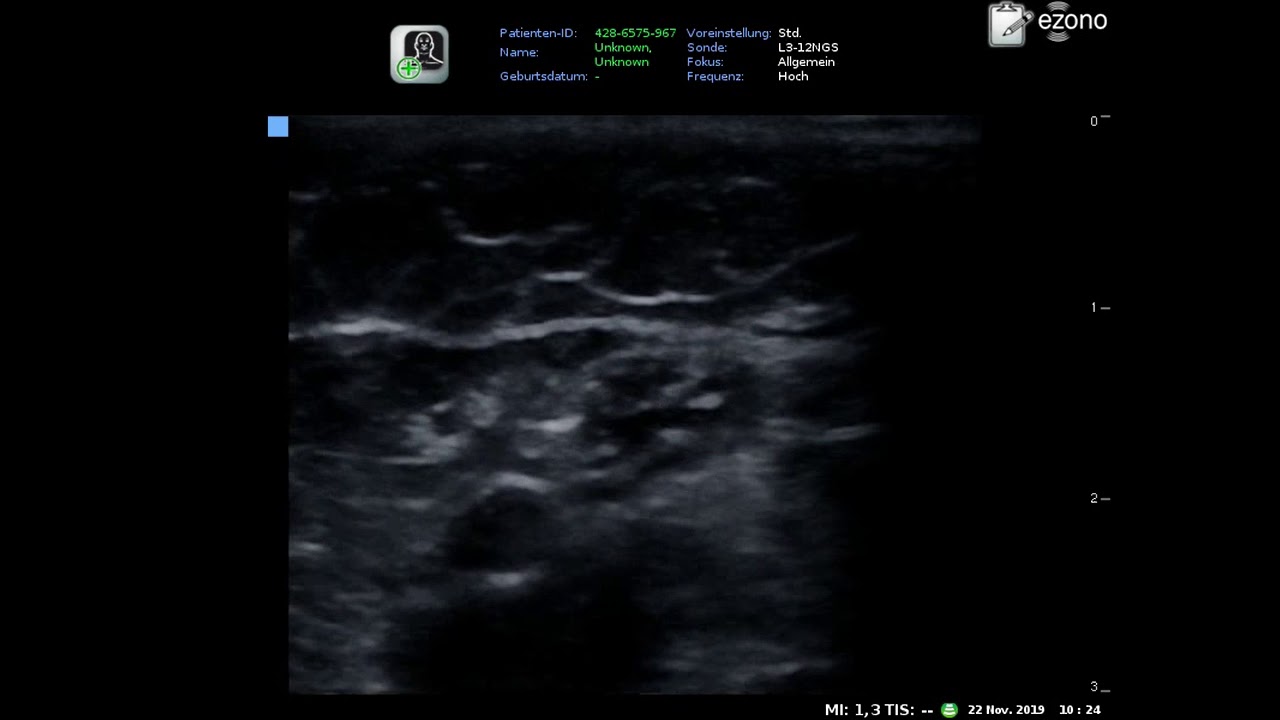 Ultrasound-Guided Axillary Plexus Brachial Block - YouTube