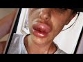 Gambar cover Increasing number of botched lip, cheek and jaw fillers sparks questions about safety | ITV News