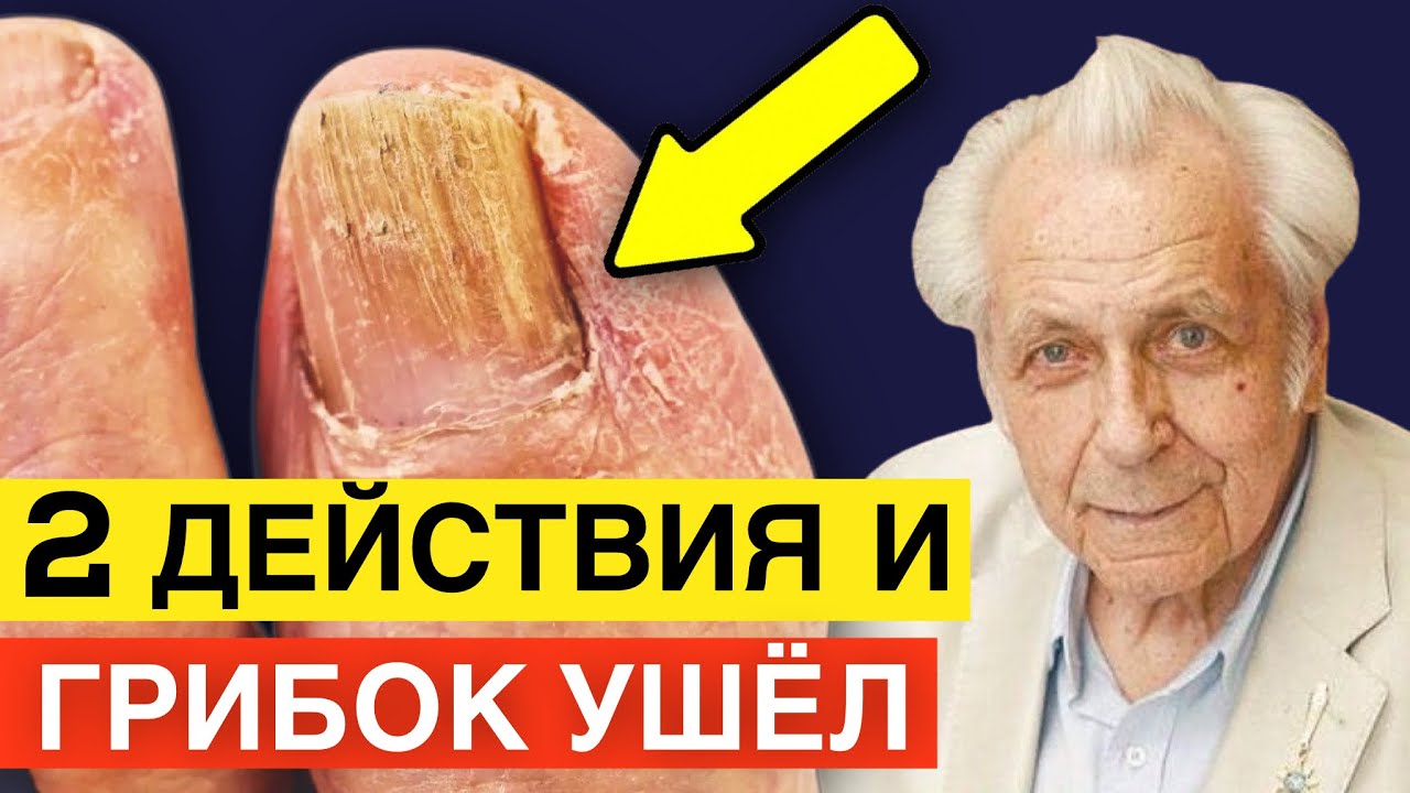 Неумывакин: Этот ПРОСТОЙ РЕЦЕПТ избавит от ГРИБКА - Навсегда! | Лечение ...