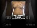 Gynecomastia Grade 4A On Table Transformation | 1.7 liters of fat and 200 grams of gland removal