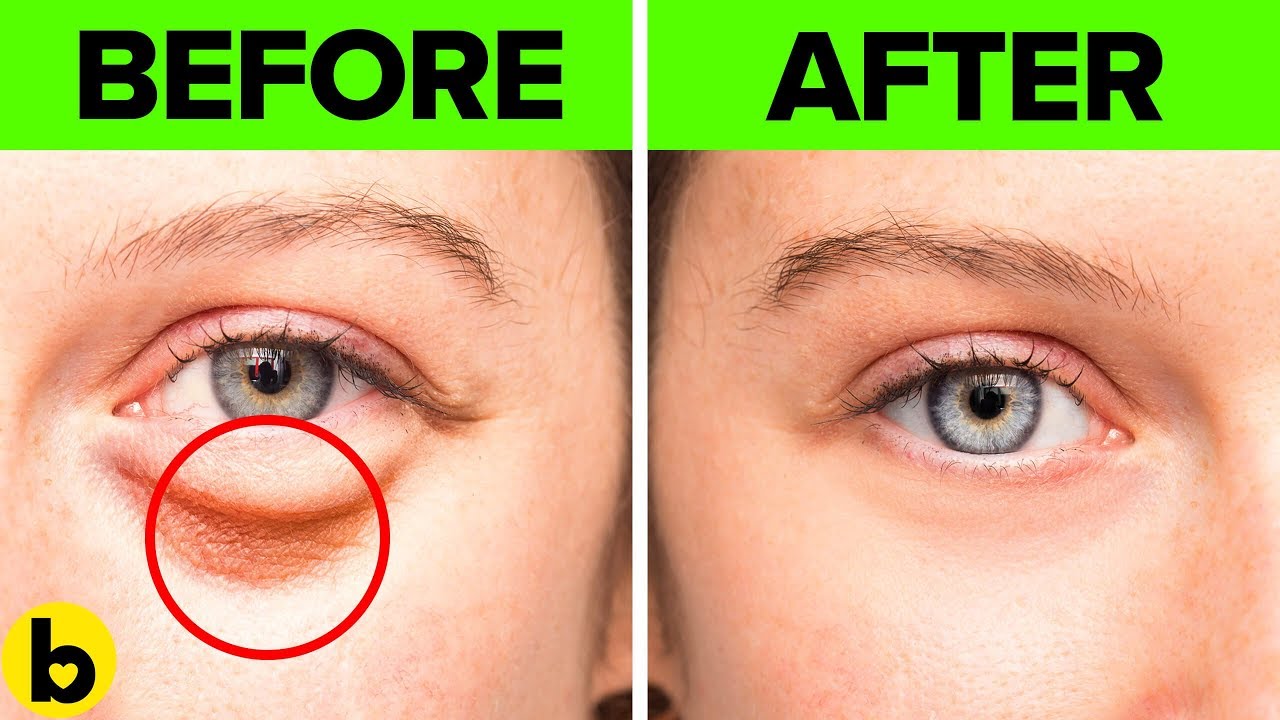 10 Natural Ways To Get Rid Of Bags Under The Eyes