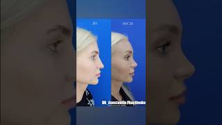 Эндоскопическая подтяжка лба и ринопластика. #подтяжкалица #ринопластика