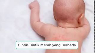 Begini Perbedaan Bintik Demam Berdarah dan Campak