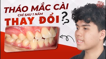 Tháo Mắc Cài Niềng Răng Lệch Lạc - Thay Đổi Nụ Cười Sau Niềng Răng Chỉ 1 Năm| Nha khoa Sdental