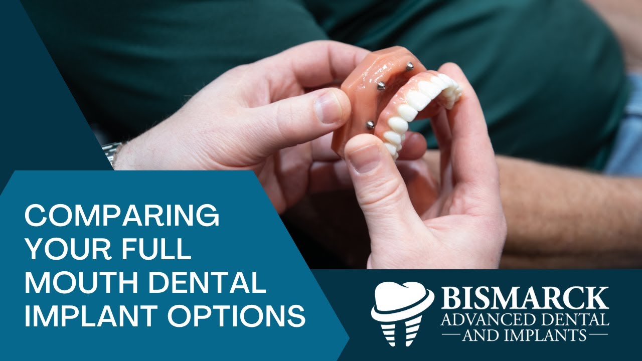 Comparing Your Full Mouth Dental Implant Options