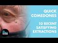 QUICK COMEDONES: 10 Recent, Satisfying Extractions