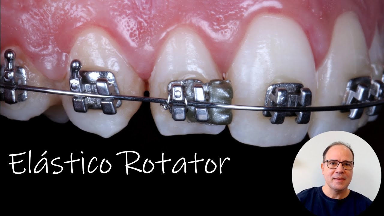 Elástico Rotator - Ortodontia