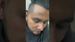 Natural Results ofHair Transplant #hairtransplant #hairtransplantinnepal #besthairtransplantinepal