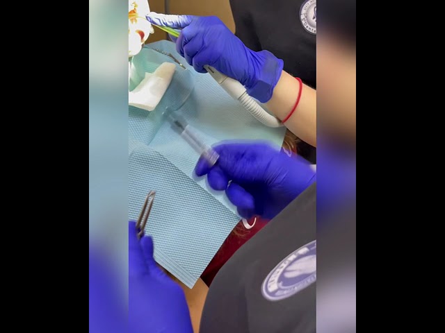 Фиксация самолигирующих брекетов Damon Q в клинике S’DENTAL