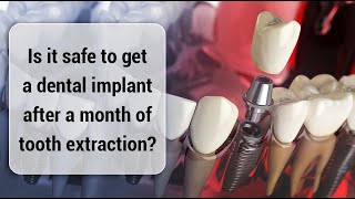 Is it safe to get a dental implant after a month of tooth extraction? ToothHQ Dental Specialists
