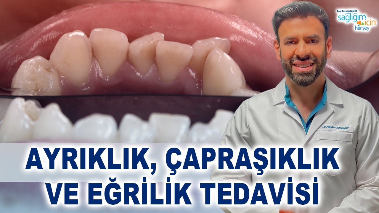 Dişlerdeki Ayrıklık, Çapraşıklık ve Eğriliklerin Tedavisi