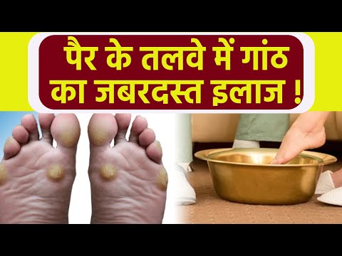 वीडियो: पैरों से काँटा कैसे हटाएं?