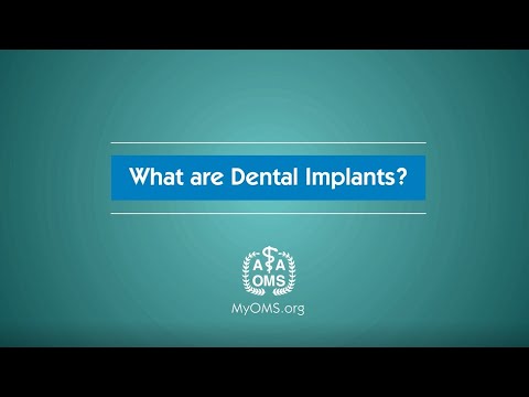 What are Dental Implants? video thumbnail