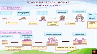 Pathogenesis of colorectal carcinoma - Dr.V.Shanthi
