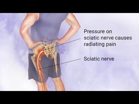 SCIATICA SOLUTIONS | Pain Management and More!