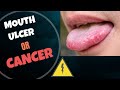 Canker sores| Features suspicious of Cancer| When is it necessary to visit a Dentist?