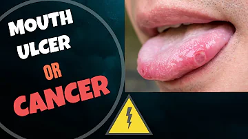 Canker sores| Features suspicious of Cancer| When is it necessary to visit a Dentist?