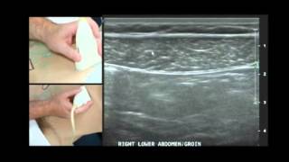 MSKUS Evaluation of the Abdomen - trailer Torn Rectus Abdominis Muscle