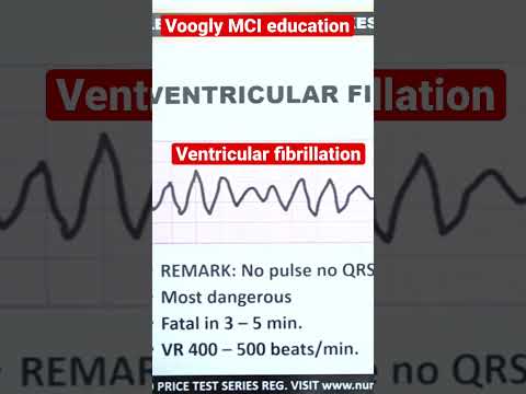 Video: Ko ietekmē fibrilācija?