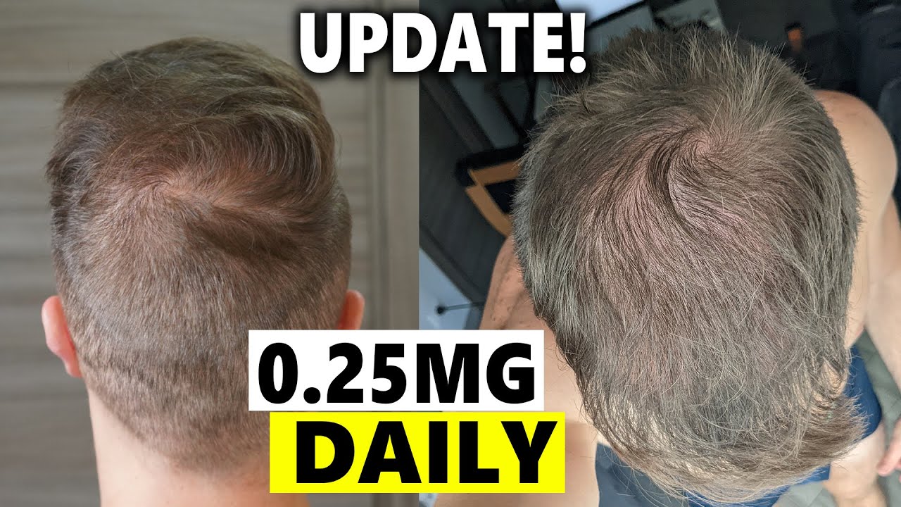 Finasteride Microdosing Update 2022! YouTube