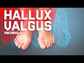 Hallux Valgus мизинца. Что с ним делать?