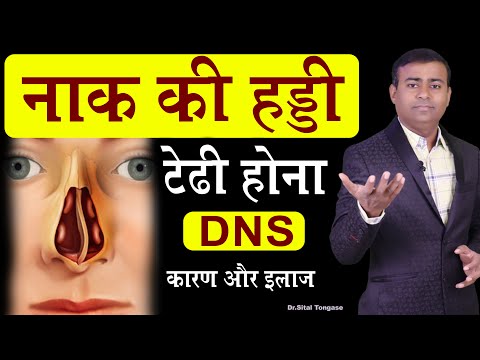 नाक की हड्डी टेढ़ी होना DNS कारण और इलाज! Deviated nasal septum Hindi