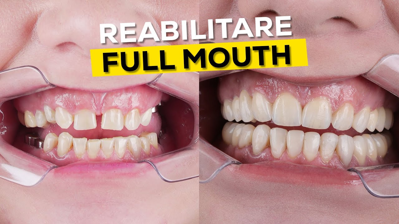 Detalii ascunse la 18 coroane ZIRCONIU + CERAMICA si 6 implanturi