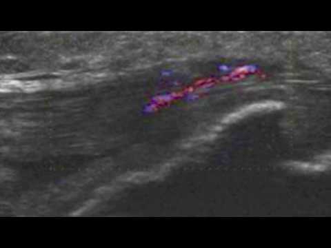 Video: Osgood Schlatter Xəstəliyi ilə Mübarizənin 3 Yolu