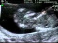 Ultrasound scan 12 weeks