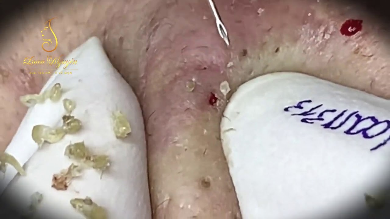 Best blackheads removal (313-1) | Loan Nguyen - youtube