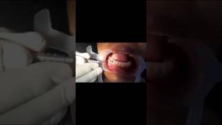 Ortho Mode on🔥 Precision in every bracket 🦷#dental_hub#dentaldailywork#smilexpert#drgarimachoudhary