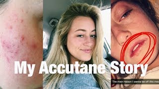 How I Cleared My Skin On ACCUTANE | My Accutane Journey