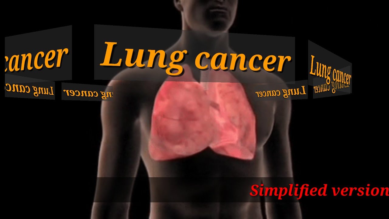 Quit smoking 🚬|Small cell lung cancer & it's complications|curable