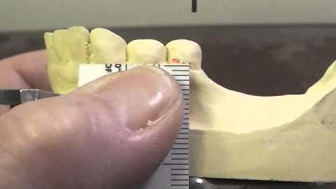 R P D Design - Ken Class I Mand Cast #2 Part B