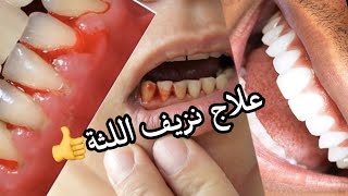 أسباب نزيف اللثة وطرق علاجها في المنزل #التهاب_اللثة