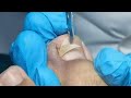 That is so painful before ingrown nails removal. Fungal nail treatment &amp; ingrown nail removal.