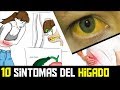 SINTOMAS DE UN HIGADO ENFERMO ▶ HIGADO GRASO