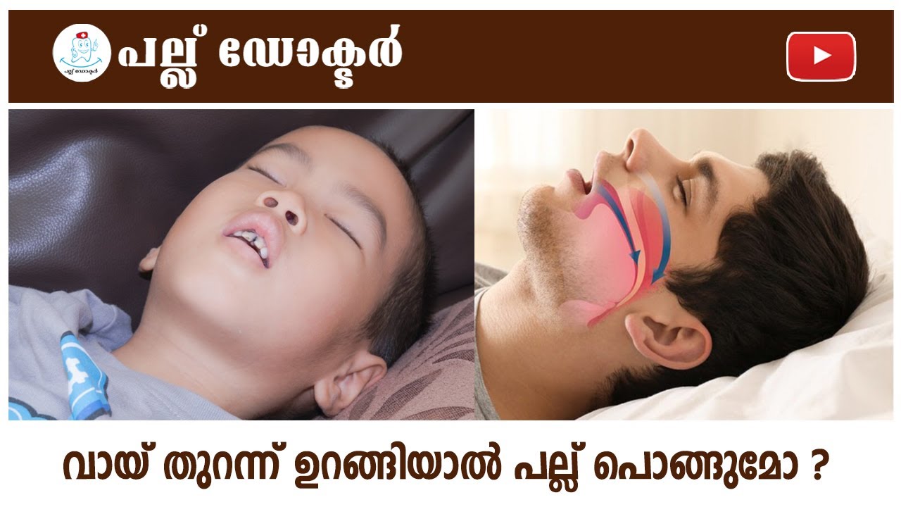 വായ് തുറന്ന് ഉറങ്ങിയാൽ പല്ല് പൊങ്ങുമോ ?/Can Sleeping with Your Mouth Open Cause Teeth to Fall Out?