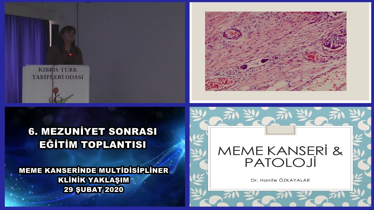 Dr  Hanife ÖZKAYALAR MEME KANSERİ & PATOLOJİ