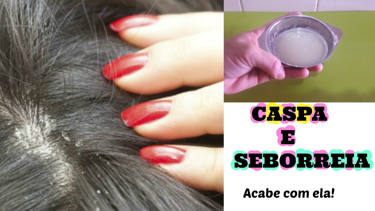 Como Acabar Com Caspa Seborreia E Dermatite Capilar Eny