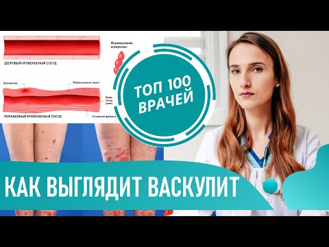 Видео: Лейкоцитокластический васкулит – это рак?