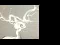 Endovascular coil embolization of unruptured posterior communicating artery aneurysm