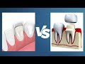 Veneers vs Crowns - Whats the Difference?