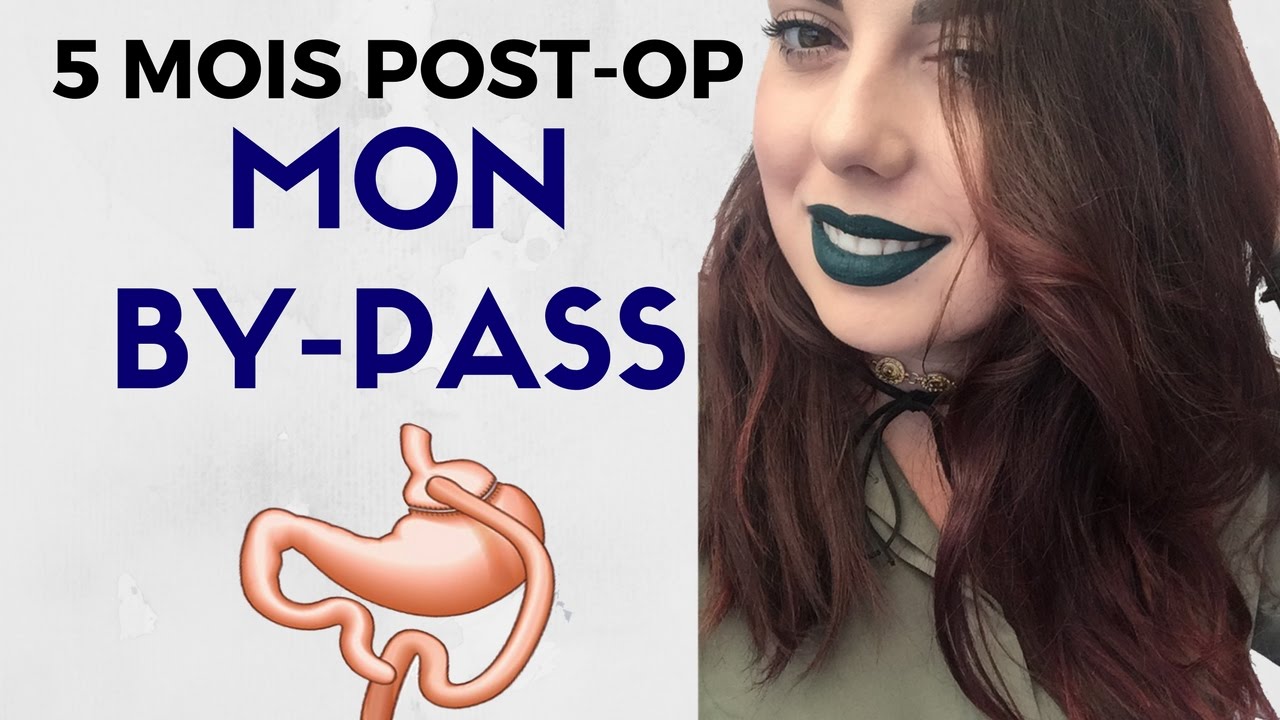 MON BY-PASS : Pré-op, chirurgie, post-op, ma perte...