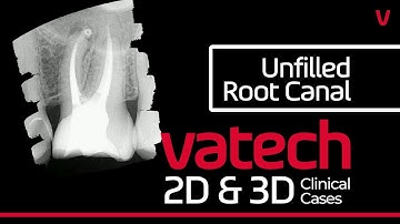 [Vatech 2D & 3D Clinical Cases] 🦷 Unfilled Root Canal