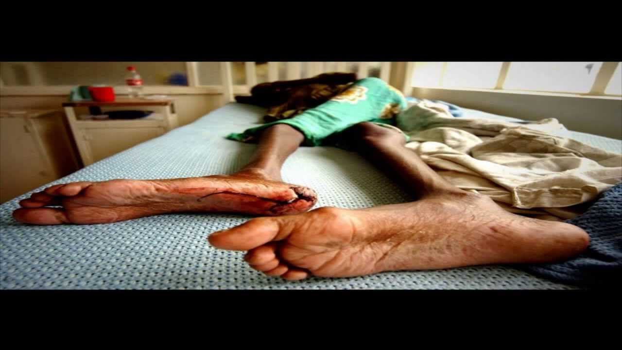 Need of new Drugs for Tuberculosis