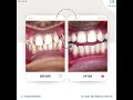"See the magic of cleaning! ✨ Book your appt. today for a brighter, healthier smile! 📞 9810165360"