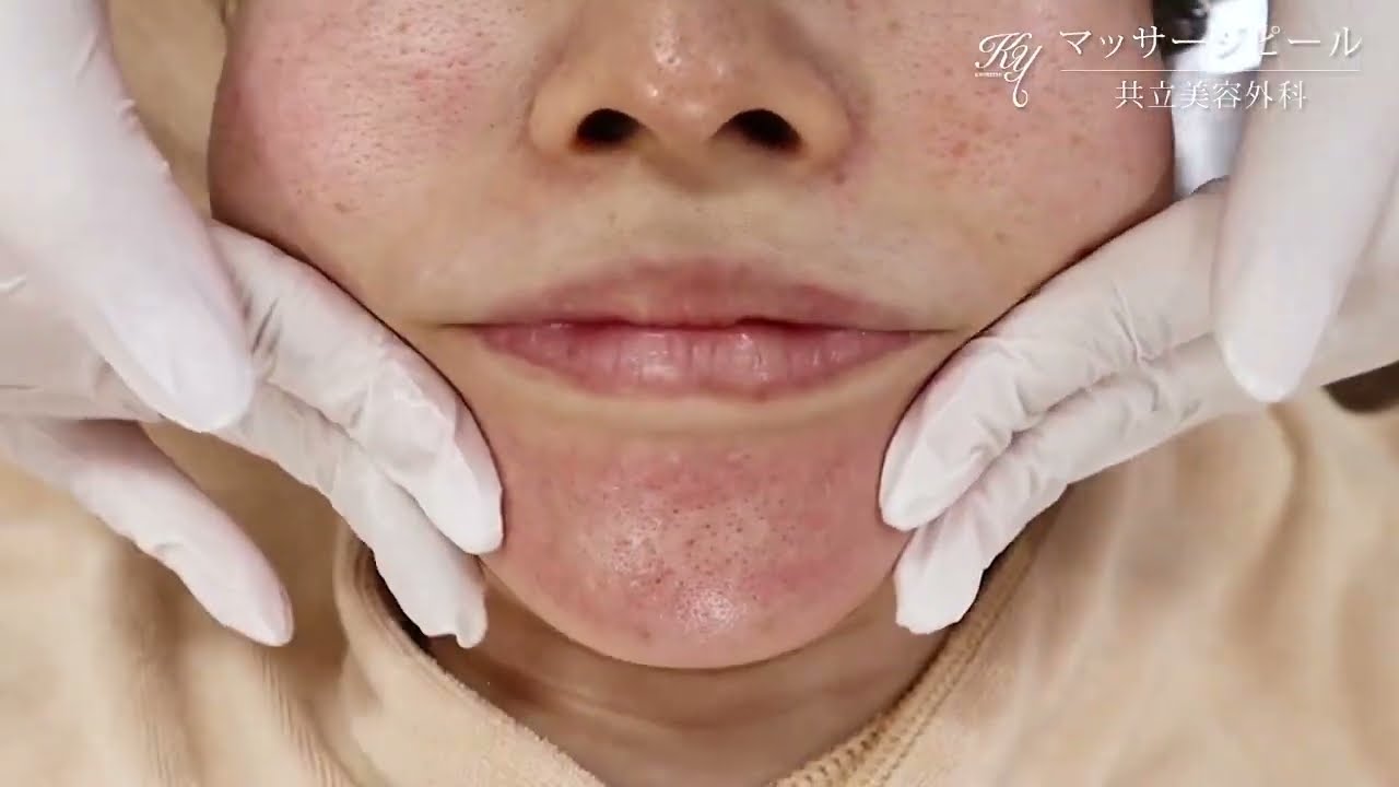 マッサージピールの施術の雰囲気 - YouTube