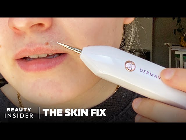 Live - Introducing OPHERA Skin Tag Remover: How to Use and